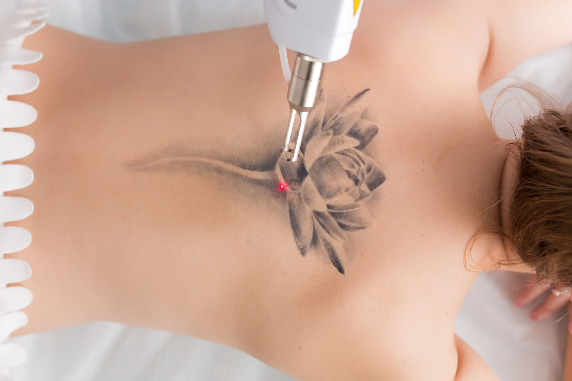Что происходит под кожей и с организмом в целом во время удаления татуировки?