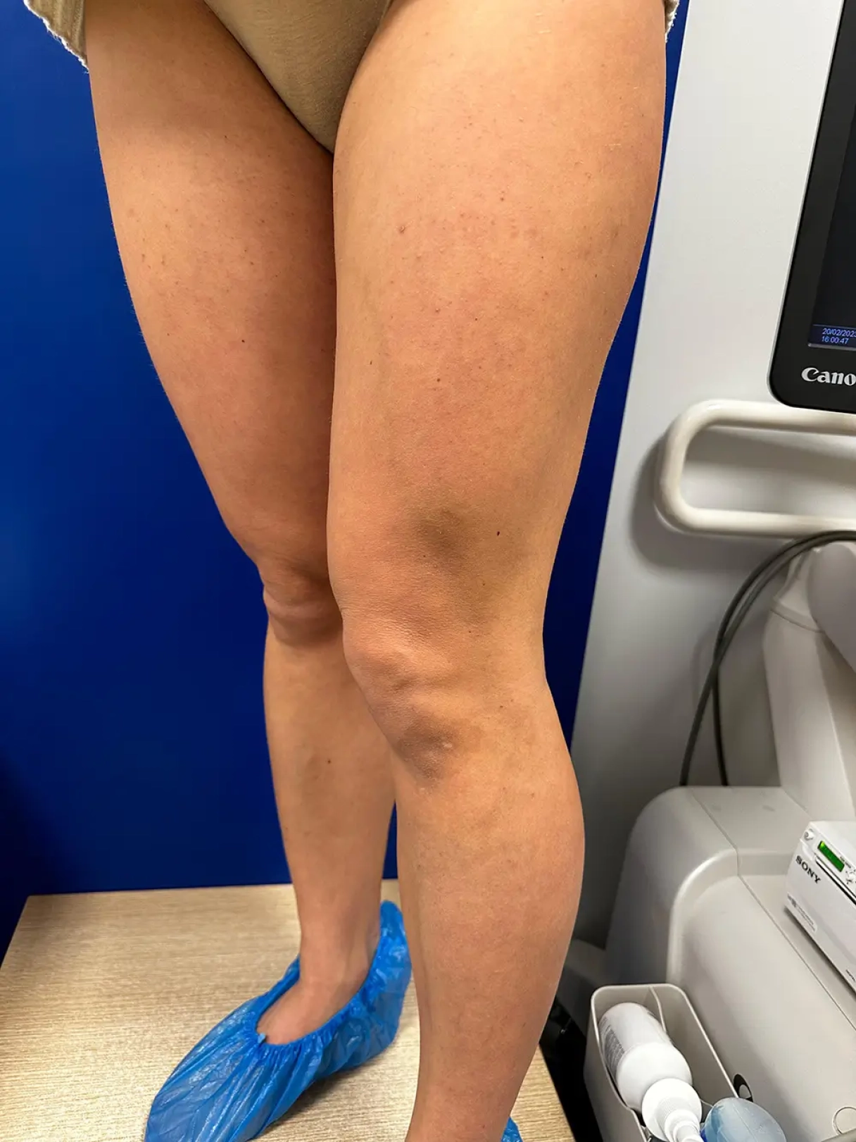 Mēnesis pēc operācijas