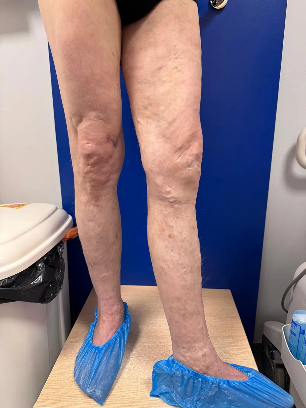 15 mēnešus pēc operācijas