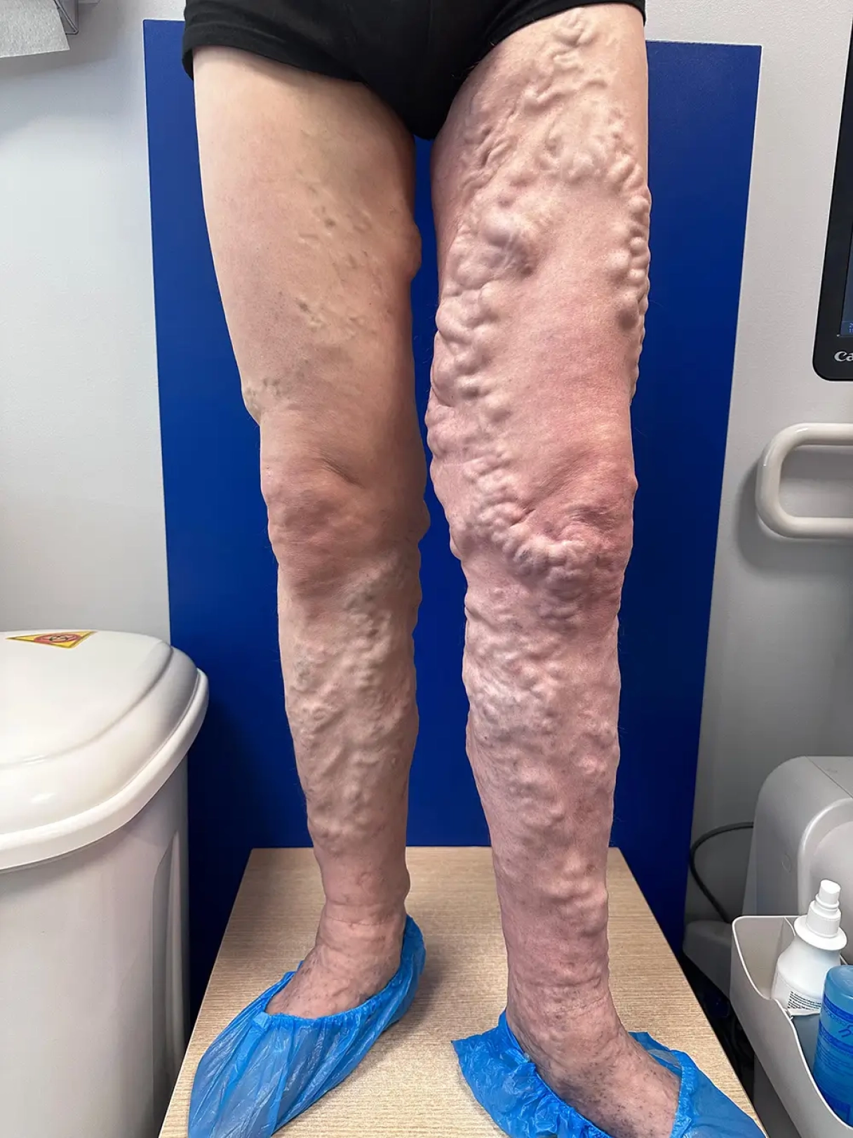 Dr.Ints Ūdris, Total EVLA metode