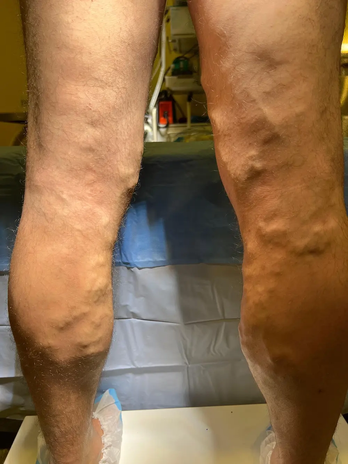 Dr.Ints Ūdris, Total EVLA metode