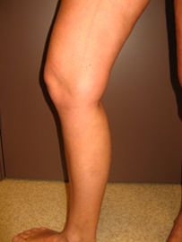 venas-pec-skleroterapijas-1