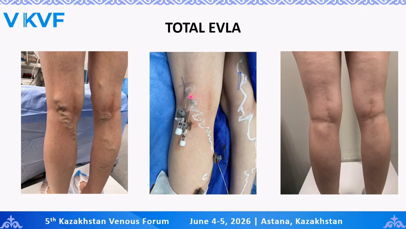 Dr. Ints Ūdris pārstāvēja Latviju starptautiskā fleboloģijas konferencē Kazahstānā "5 th Kazakhstan Venous Forum"