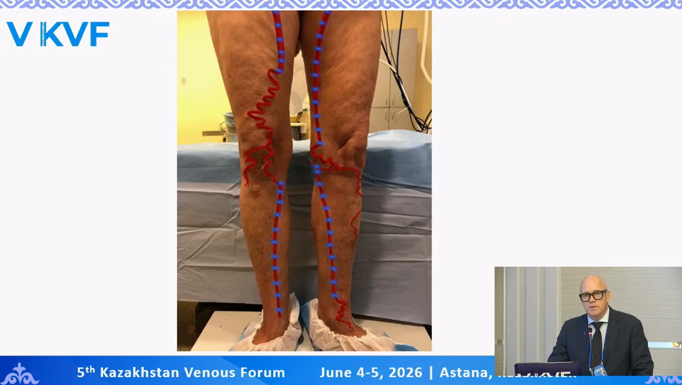 Dr. Ints Ūdris pārstāvēja Latviju starptautiskā fleboloģijas konferencē Kazahstānā "5 th Kazakhstan Venous Forum"
