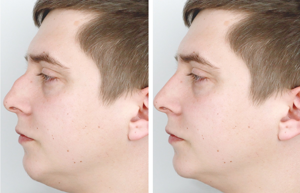 Rinoplastika_pirms un pēc