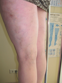 venas-pirms-skleroterapijas-2