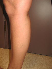 venas-pec-skleroterapijas-2