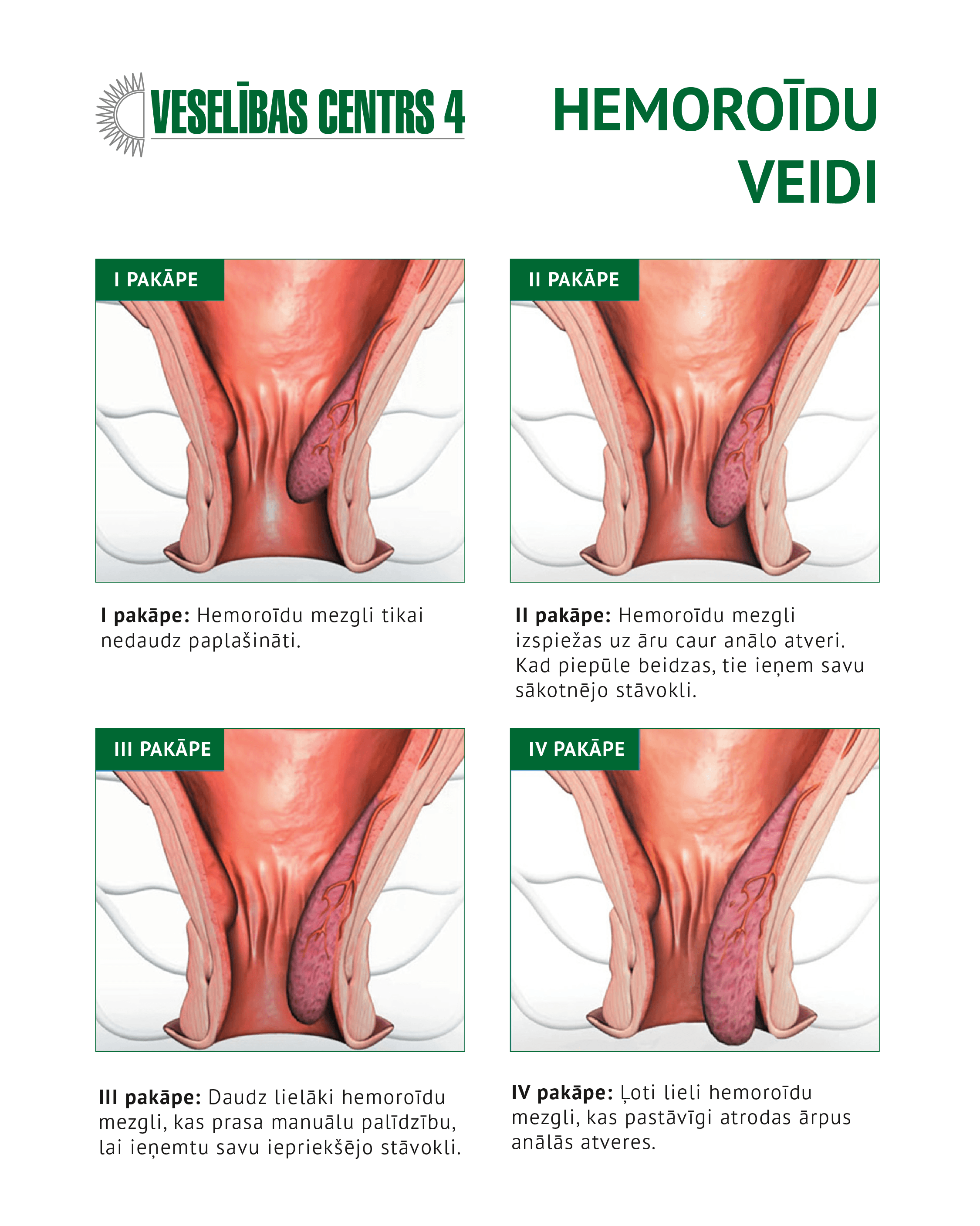 Hemoroidu veidi ar simptomiem