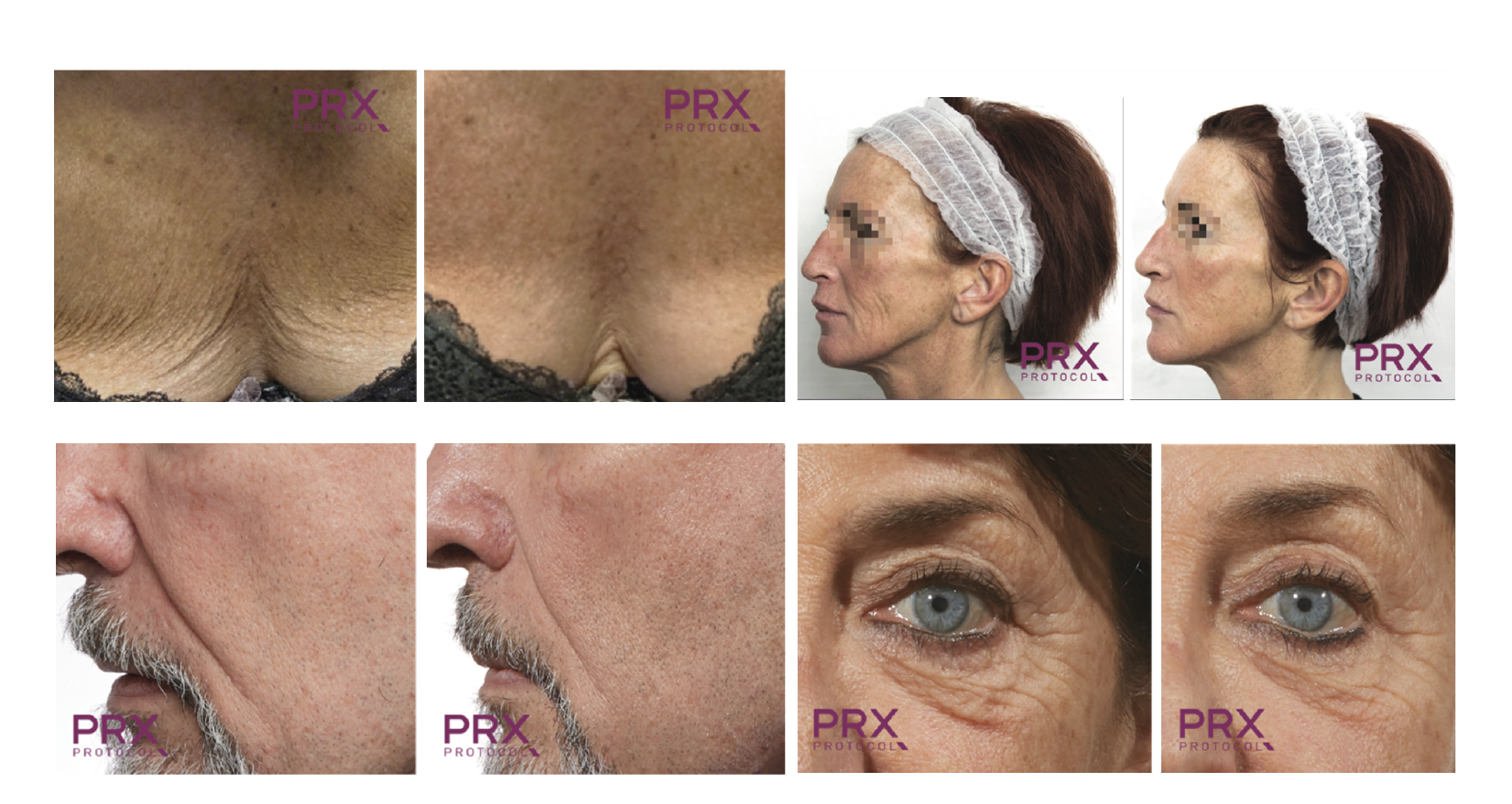 sejas pīlings TRX-33 ar biorevitalizācijas efektu, pirms un pēc rezultāti