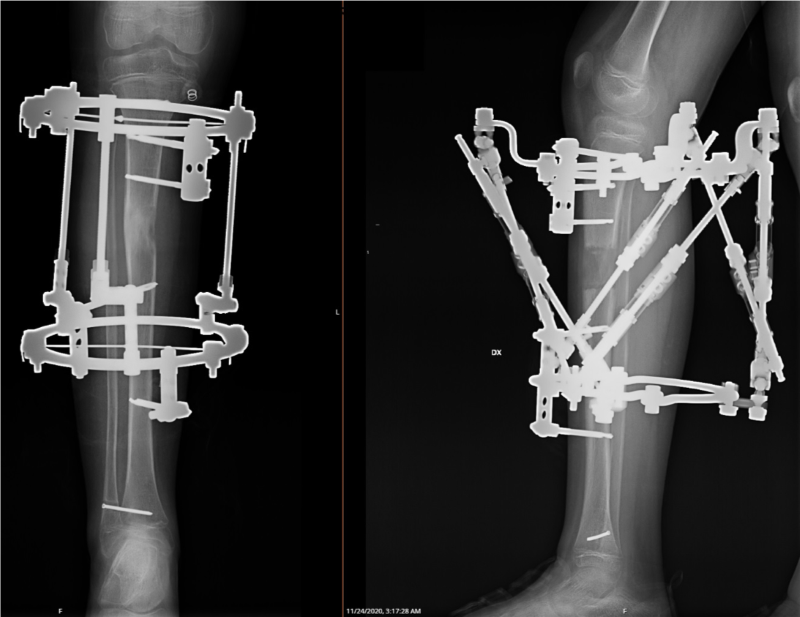 ortopēdiskā deformācija