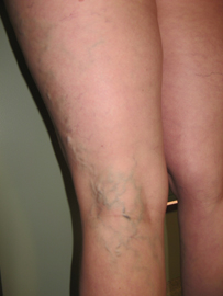 Vēnas pirms skleroterapijas_1 Vēnas pirms skleroterapijas_1