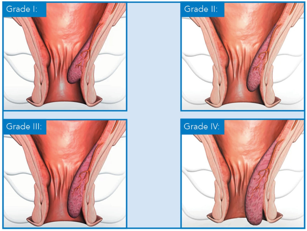 Medicīniska ilustrācija, kas attēlo hemoroīdu attīstības pakāpes no I līdz IV